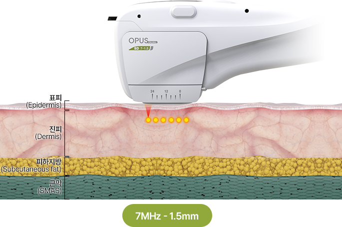 카트리지 1.5mm